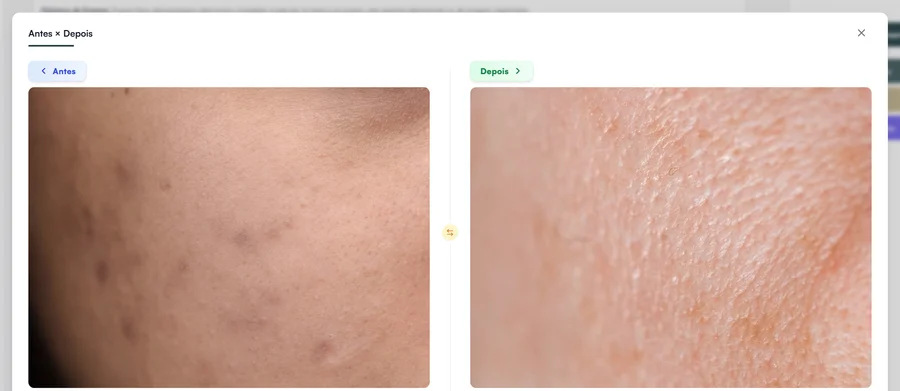 Tela Antes × Depois do Hit Clinic com duas fotos de pele em close lado a lado: à esquerda, Antes, com marcas de acne; à direita, Depois